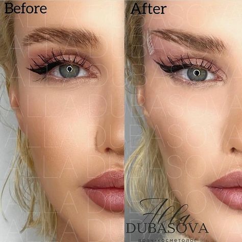 Eye Lift Surgery, Beauty Surgery, Foxy Eyes, Rhinoplasty Nose Jobs, Eye Trends, Eyebrow Lift, Cheek Fillers, Jenner Makeup, Facial Fillers