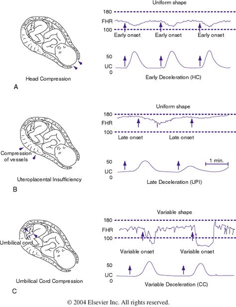 Fetal Toco... Any situation in which there are repetitive LATE Decelerations, this indicates fetal distress... It is an indication for EMERGENT C-SECTION Late Decelerations Nursing, Electronic Fetal Monitoring Nursing, Fhr Monitoring Nursing, Fetal Heart Rate Monitoring Nursing, Decelerations Nursing, Fetal Monitoring Nursing, Veal Chop Nursing, Nursing Ob, Fetal Heart Monitoring