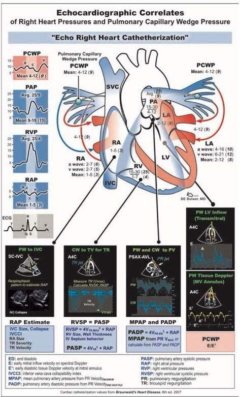 Echo. Right heart catheterization Right Heart Catheterization, Echo Cardiography, Cath Lab Nursing, Cardiovascular Nursing, Diagnostic Medical Sonography Student, Heart Catheterization, Cardiac Sonography, Sonography Student, Nurse Teaching