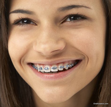 Teeth After Braces, Blue Braces, After Braces, Fix Teeth, Braces Girls, Braces Colors, Charcoal Teeth Whitening, Dental Braces, Straight Teeth