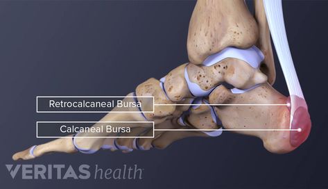 Heel (Retrocalcaneal and Calcaneal) Bursitis | Arthritis-health Heel Bursitis, Achilles Tendinopathy, Synovial Fluid, Primary Care Physician, Medical Terms, Family Medicine, Calf Muscles, Heel Pain, Sports Medicine