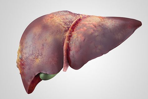 Anemia is a major risk factor for patients with both compensated and decompensated cirrhosis, increasing the odds of hepatic decompensation and/or mortality. Fashion Pollution, Human Poster, Art Gcse Ideas, Angelica Sinensis, Therapy Notes, Human Liver, Med Vet, Art App, Art Learning