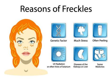 How To Remove Freckles From Face, Remove Freckles From Face, How To Get Freckles Naturally, How To Remove Freckles, How To Get Freckles, Getting Rid Of Freckles, Freckle Remover, Post Inflammatory Hyperpigmentation, Essential Oil Mixes