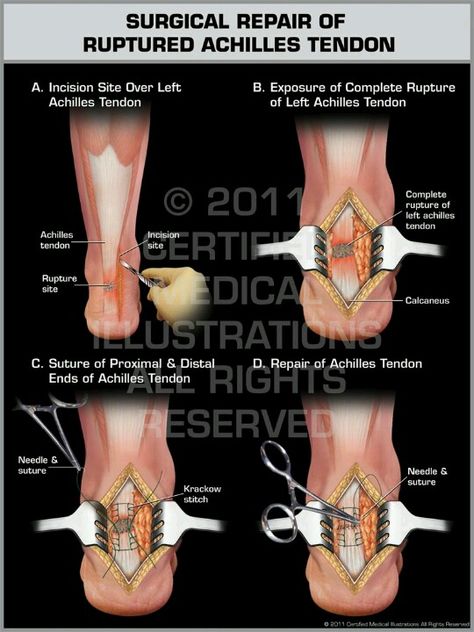 Fortunately mine isn't a complete rupture, but these pictures give the general idea! Ankle Anatomy, Achilles Tendon Ruptures, Ankle Swelling, Achilles Pain, Medical Boot, Rehab Exercises, Ankle Sprain, Ankle Surgery, Pain Relief Remedies