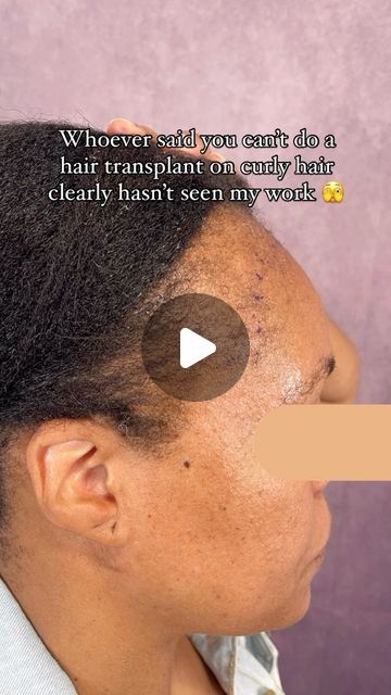 Crown Hair Institute on Instagram: "Her edges are BACK back 👏🏾 #hairtransplantresults We are 1 year post-hair transplant and she couldn’t be happier with her results. 

Traction Alopecia is no match for the hair experts at Crown Hair Institute! Book your FREE consultation with me today!

📲 (323) 947 2126
📍 150 S Rodeo Drive, Beverly Hills

#hairlinerestoration #hairlosssolution #hairlosstreatment #tractionalopecia #hairgrowthjourney" Traction Alopecia Hairstyles, Rodeo Drive Beverly Hills, Traction Alopecia, Hair Transplant Results, Back Back, Crown Hair, Rodeo Drive, Hair Transplant, Be Happier