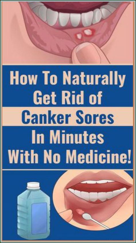 Canker Sore, Diy Remedies, Cold Sore, Natural Health Remedies, Tooth Decay, Oral Health, Health Remedies, Herbal Remedies, Natural Health