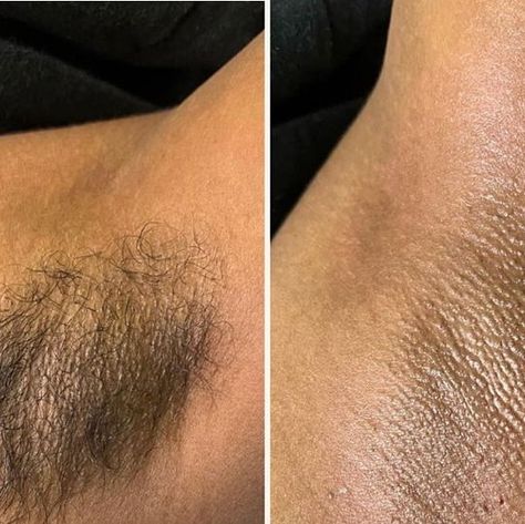 TRULYGLOWSKIN | Ottawa Waxing | Express Facials on Instagram: "🌟 Say goodbye to unwanted underarm hair and hello to smooth, beautiful skin! ✨ Check out this amazing before and after transformation from underarm waxing. Ready to experience the difference? Book with me for your next waxing session in Ottawa! 

#OttawaWaxing #SmoothSkin #UnderarmWaxing #WaxingTransformation 💫 Don’t wait, schedule your appointment today!" Waxing Before And After, Underarm Waxing, Before And After Transformation, Esthetician, Beautiful Skin, Smooth Skin, Ottawa, Facial, Skin