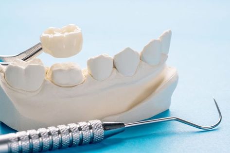 teeth crown Prosthetic Teeth, Porcelain Crowns, Tooth Crown, Dental Restoration, Dental Hospital, Dental Technician, Implant Dentistry, Dental Bridge, Dental Crowns