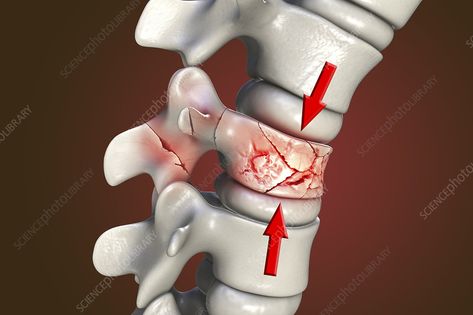 Spinal compression fracture, illustration - Stock Image - F034/7677 - Science Photo Library Library Website, Kinesiology Taping, Science Photos, Types Of Cancers, Photo Library, Science, Red