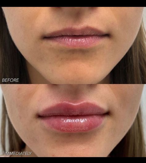 Julie Horne Lip Filler, Lip Filler Half Syringe, Downward Turned Lips, 1ml Lip Filler Before And After, Bad Lip Filler, 1 Ml Lip Filler Before And After, Pouty Lip Filler, 0.5ml Lip Filler Before And After, Lip Filler After Care