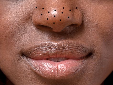 https://www.self.com/story/how-to-get-rid-of-blackheads?utm_source=nl&utm_brand=self&utm_mailing=SLF_Daily_031120&utm_campaign=aud-dev&utm_medium=email&bxid=5c48eac8fc942d0477aff71a&cndid=25495006&esrc=&utm_content=B&utm_term=SLF_Daily_GenericOpens Gentle Skin Care Routine, Blackheads On Nose, Rid Of Blackheads, Chemical Exfoliation, Types Of Acne, Blackhead Removal, Get Rid Of Blackheads, Skin Medica, Acne Remedies