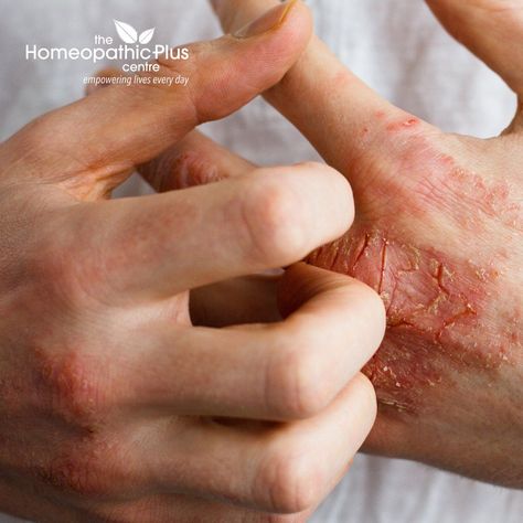 The exact cause of what causes eczema is not known. However, it is suggested that the reasons could be a mix of genetics and response of the immune system to the environment, which causes an inflammatory reaction of the skin and surfaces as eczema.  Read More at HomeopathicPlusCentre.com @hermeetsinghsuri #homeopathicpluscentre.com Atopic Skin, Skin Facts, After Sun, Skin Diseases, Dry Scalp, Vitamin B12, Healing Process, Skin Elasticity, Eye Care