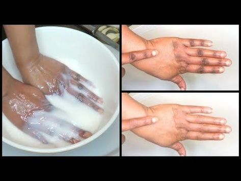 Dark Hands Remedies, How To Remove Dark Knuckles, Younger Looking Hands, Khichi Beauty, Softer Hands, Dark Spots On Legs, Skin Lightening Diy, Dark Hands, Dark Knuckles