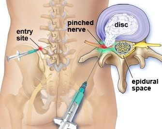 Epidural steroid injection ESI fig3 Sciatic Nerve Pain Relief, Joints Pain Remedy, Lumbar Disc, Lumbar Pain, Spine Pain, Bulging Disc, Disk Herniation, Spinal Nerve, Sciatica Pain Relief