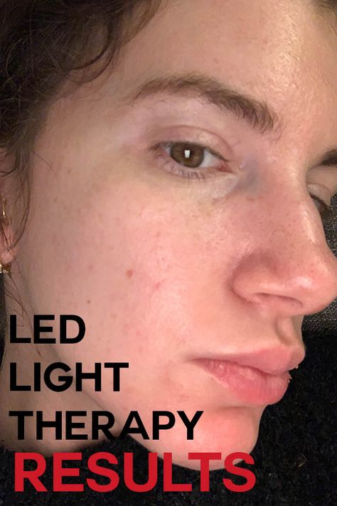 LED light therapy has led me to clearer, glowing skin. Find out how long it took, what you need, and see the progress shots Led Therapy Skin Lights, Led Light Face Therapy, Led Red Light Therapy Skin Care, Led Mask Therapy, Light Therapy For Skin, At Home Skincare, Led Light Therapy Skin, Led Light Facial, Red Led Light Therapy