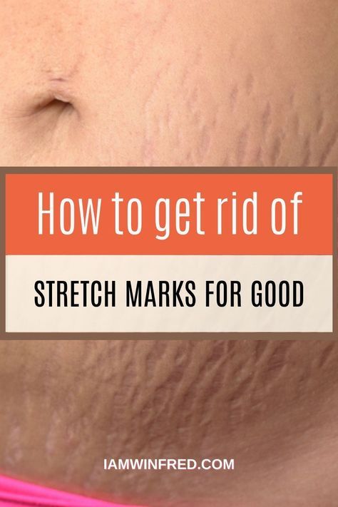 Best Under Eye Cream, Strech Marks, Stretch Mark Remedies, Medical Words, Stretch Mark Removal, Stretch Mark Cream, Eye Cream For Dark Circles, Stretch Mark, Pregnancy Care