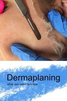 Dermaplaning Vs Waxing, How Often To Dermaplane, Dermaplaning Aesthetic, Peach Fuzz On Face, Derma Planning, Medical Esthetics, Dermaplane Facial, Dermaplaning Facial, Popular Everything