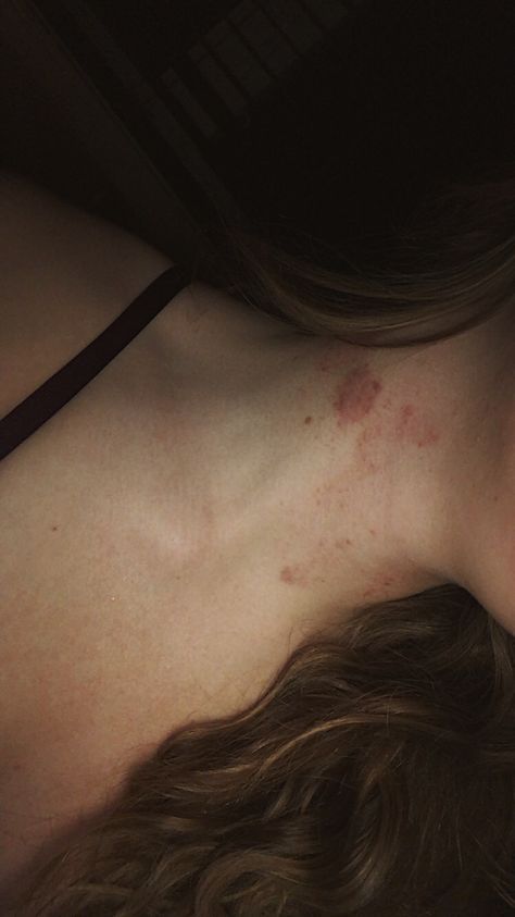 #hickey #hickeys #neck #lovebites Strangled Neck Aesthetic, Lovebites Mark Aesthetic, How To Make Fake Hickies Neck, Hicks On Neck Girl, Hicks On Neck Aesthetic, Hickey Aesthetique Dark Skin, Hickies Neck Snapchat, Neck Pictures Aesthetic, Neck Mark Kiss