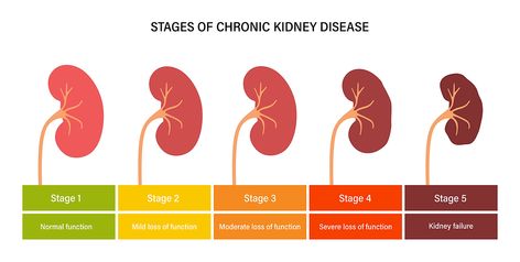 Do you know your stage of Chronic Kidney Disease? Pediatric Medicine, Polycystic Kidneys, Good Blood Pressure, Kidney Function, Chronic Kidney, Kidney Health, Hormone Imbalance, Disease, Slides