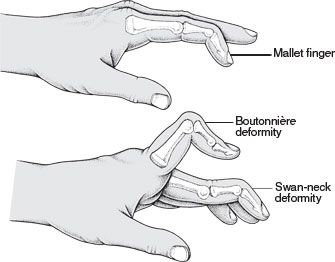 mallet-bout-swan Nbcot Exam, Pt School, Mallet Finger, Physical Therapy Student, Occupational Therapy Assistant, Swan Neck, Medical Anatomy, Hand Therapy, Emergency Medicine