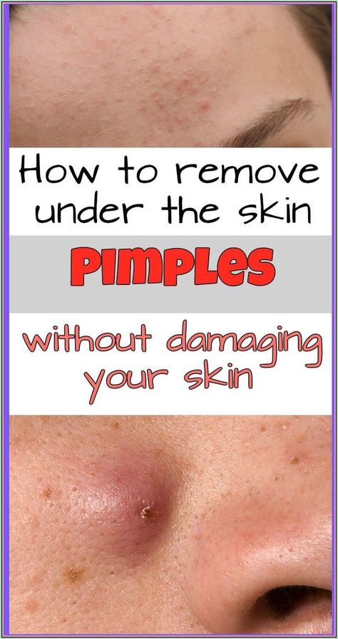 How to Remove Under the Skin Pimples Without Damaging Your Skin Under The Skin Pimples, Pimples Under The Skin, Health Signs, Under The Skin, Acne Cream, Smokey Eyes, Health Facts, Homecoming Makeup, The Skin