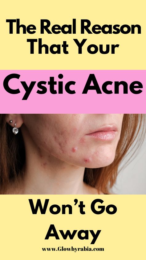 cystic acne Cystic Acne Popping, Face Map Acne, Cetaphil Acne, Acne Popping, Products For Acne Prone Skin, Clear Acne Fast, Get Rid Of Cystic Acne, Acne Face Map, Clear Skin Products