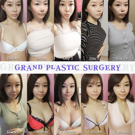 Teardrop Implants, Korean Breast, Plastic Surgery Korea, Body Structure, Prom Dresses Long Mermaid, Reconstructive Surgery, Brow Lift, Preventative Health, Breast Lift