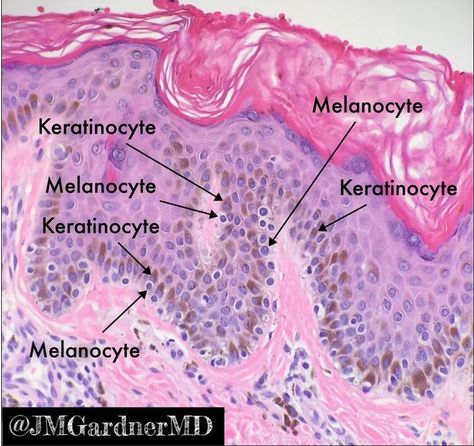 "Lentiginous nevus. Perfect example of melanocytes (grey, not pigmented) vs basal keratinocytes (lots of brown melanin). Melanocytes make pigment but keratinocytes store it. Thus melanocytes usually don't contain much visible pigment microscopically. Surprising, huh? #Pathology #dermpath " - Jerad Gardner, MD Dermatopathologist Anatomi Dan Fisiologi, Histology Slides, Oral Pathology, Medicine Notes, Craniosacral Therapy, Sistem Pencernaan, Vet Medicine, Basic Anatomy And Physiology, Nurse Study Notes