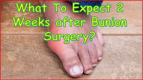 Bunion Surgery: What To Expect 2 Weeks after Bunion Surgery? Continue reading at https://buniondr.com/what-to-expect-2-weeks-after-bunion-surgery/ | BUNION DR Bunionette Surgery, Bunionectomy Recovery, Happy Mommy, Surgery Recovery, After Surgery, Post Surgery, Surgery, Repair