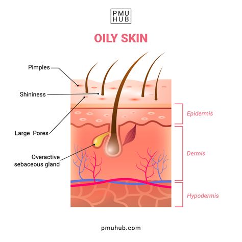 oily skin, how to determine your skin type, skin types Layers Illustration, Combination Skin Routine, Skin Anatomy, Forehead Acne, Oily T Zone, Skin Layers, Normal Skin Type, Skin Burns, Natural Acne Remedies