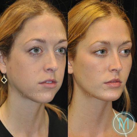 Facial Fat Grafting, Fat Grafting Face, Fat Transfer To Face, Blake Lively Nose, Jawline Contour, Face Plastic Surgery, Dream Face, Chiseled Jawline, Anti Aging Skin Care Diy