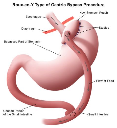 Roux-en-Y Gastric Bypass Weight-Loss Surgery | Johns Hopkins Medicine Health Library Bariatric Lifestyle, Pouch Reset, Childrens Vitamins, Sleeve Gastrectomy, Bariatric Eating, Bypass Surgery, Gastric Bypass, Bariatric Recipes, Lifestyle Tips