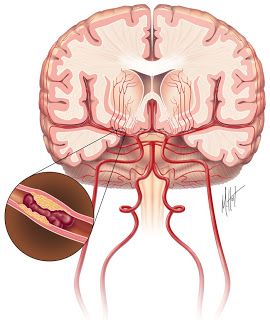 Intracranial Hemorrhage, Subarachnoid Hemorrhage, Types Of Strokes, Intracranial Pressure, Cerebrospinal Fluid, Severe Headache, Neurology, Clinical Trials, Blood Vessels