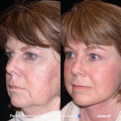 Facelift Recovery, Facial Before And After, Surgery Prep, Nonsurgical Nose Job, Face Plastic Surgery, Face Aging, Skin Tightening Procedures, Face Lift Surgery, Types Of Skin