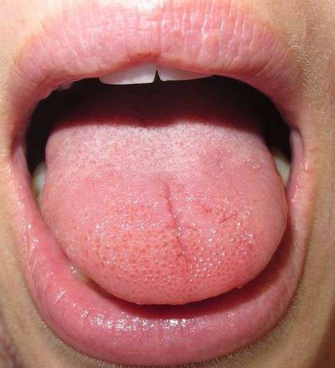 a tongue Bad Taste In Mouth, Canker Sore Causes, Burning Tongue, Burnt Tongue, Tongue Sores, Sore Lips, Tongue Scrapers, Swollen Tongue, Feeling Numb