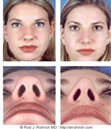 Tip Rhinoplasty, Nose Rhinoplasty, Chin Reduction, Nose Tip, Bulbous Nose, Chin Implant, Rhinoplasty Nose Jobs, Nose Reshaping, Rhinoplasty Before And After