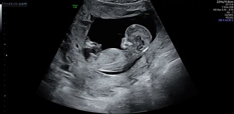 What does you baby look like at 12 weeks - pregnancy 4D ultrasound 12 Week Ultrasound Pictures, 12 Week Ultrasound Gender, 12 Weeks Pregnant Ultrasound, 15 Week Ultrasound, Boy Ultrasound Pictures, 13 Week Ultrasound, Boy Ultrasound, 12 Week Ultrasound, 16 Weeks Pregnant Ultrasound