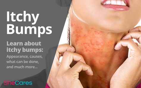 Small, red, itchy bumps on the skin are a common presentation of several different rashes. Learn all about itchy bumps here! https://www.shecares.com/symptoms/itchy-skin/all-about-itchy-bumps #SheCares #women #Health #wellness #itchybumps #itchyskin Rash On Buttocks, Home Remedies For Rashes, Leg Rash, Home Remedies For Face, Itchy Skin Rash, Rash On Face, Rash On Neck, Redness Pimple, Itchy Face