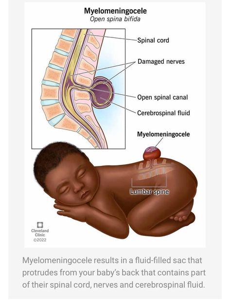 Myelomeningocele is a type of spina bifida — a birth defect in which your baby’s spine and spinal canal don’t close before birth. Healthcare providers can usually diagnose myelomeningocele during pregnancy and perform surgery during pregnancy or after birth to repair the opening in your baby’s spine. #spinabifidastrong #spinabifidawarrior #spinabifida #spinabifidaawareness #parenting #charity Pediatric Nursing Study, Obstetrics Nursing, Spina Bifida Awareness, Midwifery Student, Weeks Of Pregnancy, Nursing School Motivation, Medicine Notes, Spina Bifida, Nursing School Humor