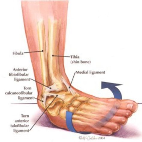 FRIDAY FOCUS - Spraining/tearing the lateral ligaments of the ankle (i.e. going over on the outside of your ankle) are among the most common injuries that people experience during sports. The most commonly injured ligament on the outside of the ankle is referred to as the anterior talofibular ligamental (ATFL) which is one of 3 main lateral ligaments. The ankle joint moves in many ways. During movement there is a degree of rolling and sliding that occurs. Ligaments on the outside of the ankl... Ankle Anatomy, Ankle Ligaments, Twisted Ankle, Ligament Tear, Ankle Pain, Muscle Anatomy, Human Anatomy And Physiology, Ankle Injury, Medical Anatomy