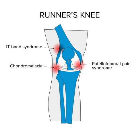 Runners Knee Exercises, Running Knee Pain, Recovery Exercises, Shin Splint Exercises, Knee Pain Relief Remedies, Body Facts, Runners Knee, Human Body Facts, Pain Relief Remedies