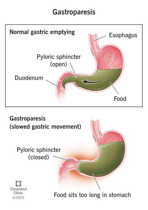 Body Knowledge, Dairy Free Breastfeeding, Gastrointestinal Disease, Muscle Twitching, Stomach Muscles, Vagus Nerve, Nerve Damage, Cleveland Clinic, Stomach Pain