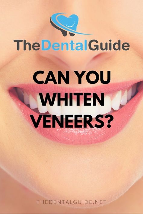 Can You Whiten Veneers? - The Dental Guide http://www.thedaviedentist.com/home Tooth Extraction Aftercare, Zoom Teeth Whitening, Zoom Whitening, Braces Cost, Sensitive Teeth Remedy, Teeth Whitening Homemade, Veneers Teeth, Dental Implants Cost, Teeth Whitening Remedies