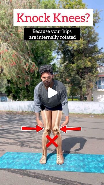 Fix Knock Knees Exercise, How To Fix Knock Knees, How To Get Rid Of Knock Knees, Knock Knees Exercises, Knock Knees, Yoga For All, Knee Exercises, Hip Openers, April 6