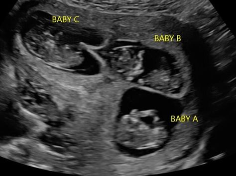 An early first trimester ultrasound with triplets. 10 Week Ultrasound, Pregnant With Triplets, Baby Ultrasound Pictures, Triplets Pregnancy, Pregnancy Ultrasound, Bump Pictures, Baby Ultrasound, Triplet Babies, Do Hard Things