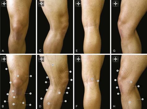 Knee Anatomy and Biomechanics of the Knee | Musculoskeletal Key Knee Shading, Knees Anatomy, Knee Structure, Knee Reference, Knees Reference, Anatomy Knee, Knee Drawing, Knee Anatomy, Leg Reference