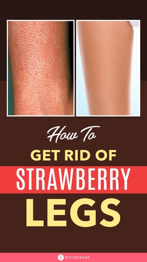 How To Get Rid Of Strawberry Legs – 3 Simple Steps To Soft And Beautiful Legs #BeautyTips #SkinCare #StrawberryLegs #Tips #Tricks Back Hair Removal, Camouflage Makeup, Mascara Hacks, Strawberry Legs, Underarm Hair Removal, Unwanted Facial Hair, Hair Removal Methods, Facial Hair Removal, Hair Removal Permanent