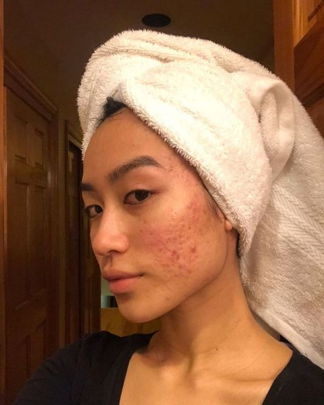 Girl With Acne, How To Get Rid Of Pimples, Normal Body, Bare Beauty, Love Your Skin, Pretty Skin, Raw Beauty, Beauty Standards, Acne Skin