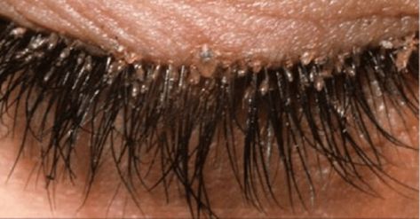 What Are Eyelash Mites? Woman Suffers Redness In Eyes Due To Parasites Eye Mites, Mites On Humans, Demodex Mites, Eyelash Extentions, Natural Eyelashes, Stimulate Hair Growth, Hair Follicle, Lavender Essential Oil, Skin Care Regimen