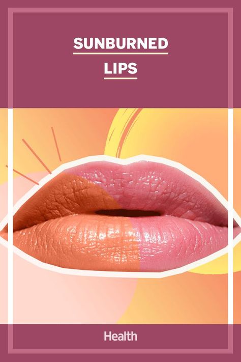 Sun Blisters, Sunburnt Lips, Blister Remedies, Blister On Lip, Sunburned Lips, Sunburn Peeling, Sore Lips, Lips Peeling, Sunburn Remedies